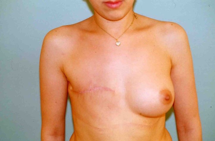 Photos avant après – la reconstruction différée : Avec une peau très souple, image 1 sur 4