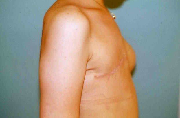 Photos avant après – la reconstruction différée : Avec une peau très souple, image 3 sur 4