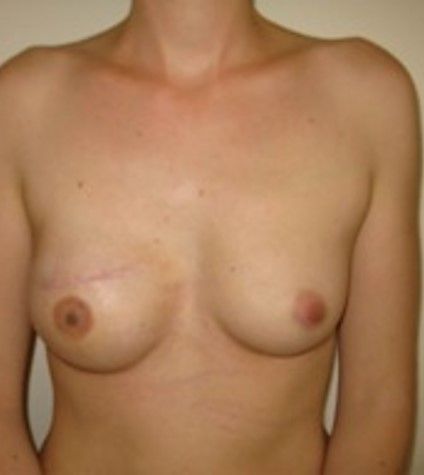 Photos avant après – la reconstruction différée : par grand dorsal et prothèse à droite, image 1 sur 2