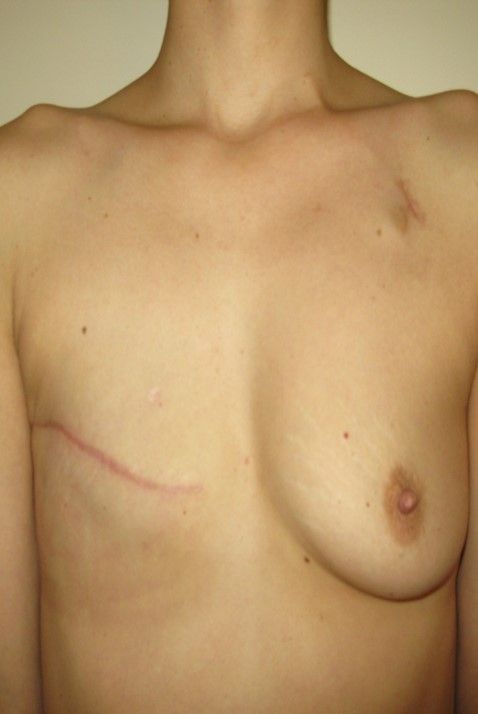 Photos avant après – la reconstruction différée : par grand dorsal avec prothèse, image 1 sur 4