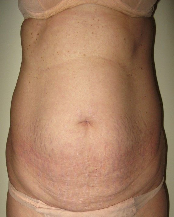La chirurgie esthétique du ventre : lipoaspiration : allège la taille, affine la paroi de l’abdomen et redresse la silhouette, image 1 sur 4