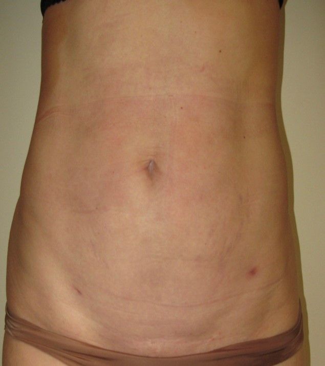 La chirurgie esthétique du ventre : lipoaspiration : allège la taille, affine la paroi de l’abdomen et redresse la silhouette, image 2 sur 4