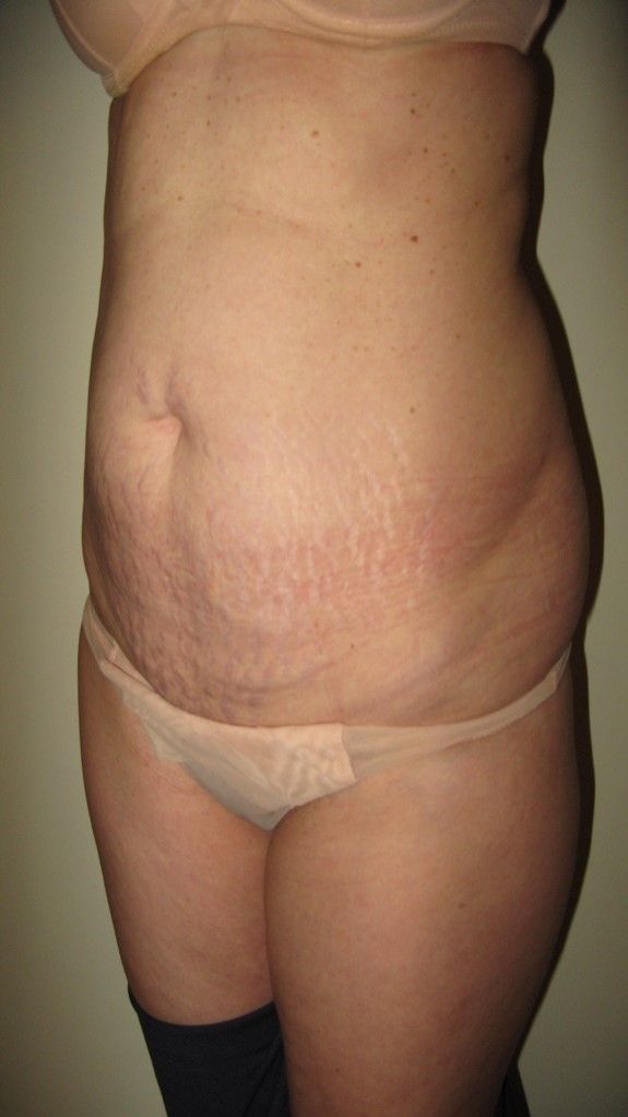 La chirurgie esthétique du ventre : lipoaspiration : allège la taille, affine la paroi de l’abdomen et redresse la silhouette, image 3 sur 4
