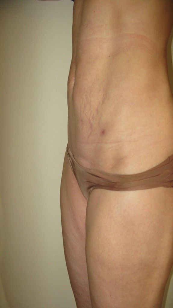 La chirurgie esthétique du ventre : lipoaspiration : allège la taille, affine la paroi de l’abdomen et redresse la silhouette, image 4 sur 4