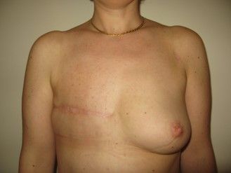 Photos avant après – la reconstruction différée : par lambeau de grand dorsal, image 1 sur 4