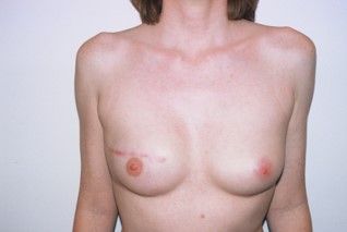 Photos avant – après la reconstruction immédiate par prothèse : par lambeau de grand dorsal, image 2 sur 2