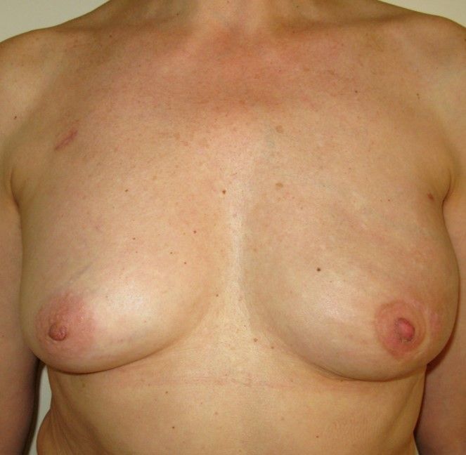 Photos avant – après la reconstruction immédiate par prothèse : la technique du grand dorsal, image 2 sur 2