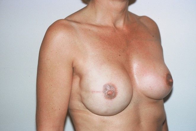 Photos avant – après la reconstruction immédiate par prothèse : lambeau de grand dorsal, image 1 sur 2