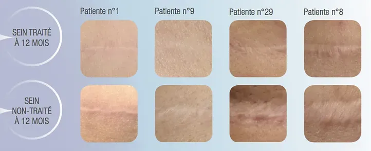 Exemples de résultats comparés par patiente avec et sans traitement laser post‑opératoire de la cicatrice (source UrgoTouch, étude réalisée sur 40 patientes dans le service de Chirurgie plastique et réparatrice de l’Hôpital de la Conception à Marseille dirigé par le Professeur Casanova).