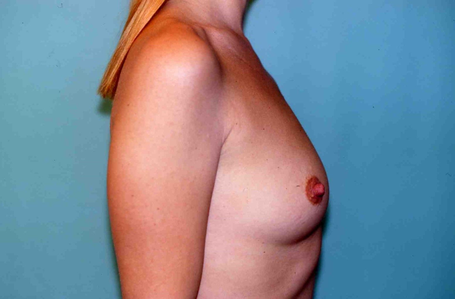 Laure avant l'opération, vue de profil